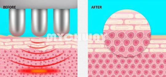 MacSure, RF Fractional - Includes x5 Tips