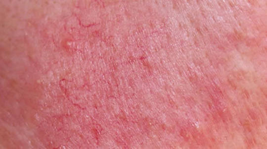 Rosacea: Triggers and subtype classification