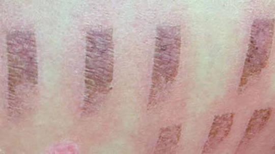 Module 2: Skin & Hair Reactions to Light Based Therapy