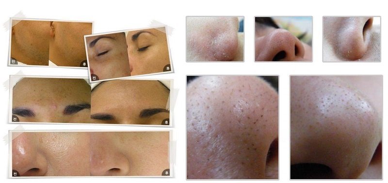 Hydrabrasion-Peel-Concentrate-Before-and-After