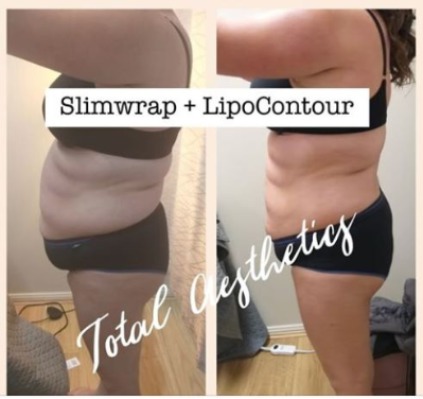 Slimwrap-before-after-718-93