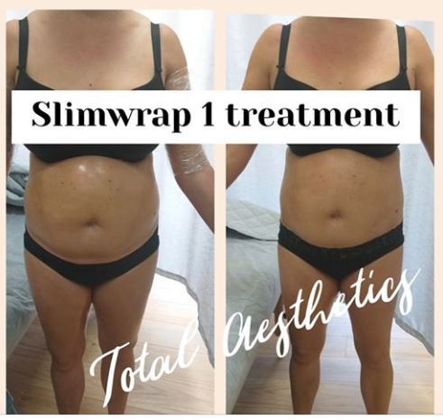 Slimwrap-before-after-2
